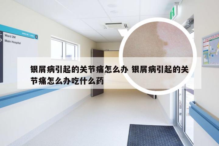 银屑病引起的关节痛怎么办 银屑病引起的关节痛怎么办吃什么药