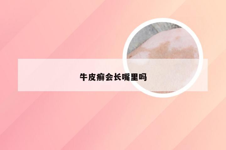 牛皮癣会长嘴里吗