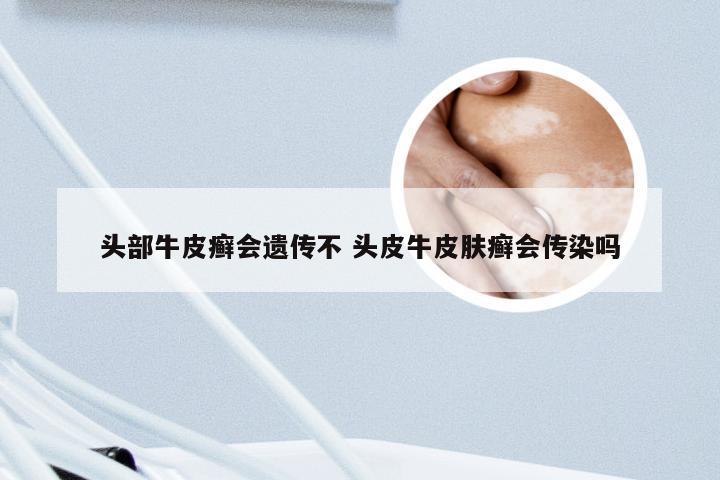 头部牛皮癣会遗传不 头皮牛皮肤癣会传染吗