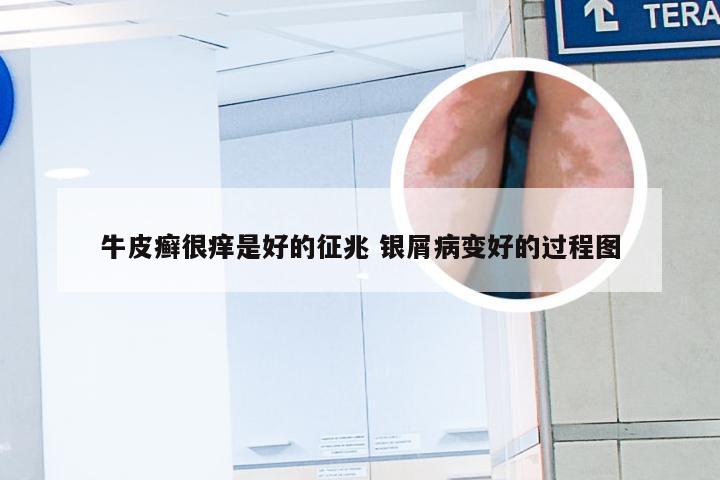 牛皮癣很痒是好的征兆 银屑病变好的过程图
