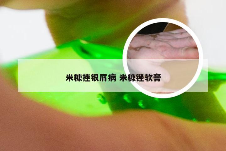 米糠挫银屑病 米糠锉软膏