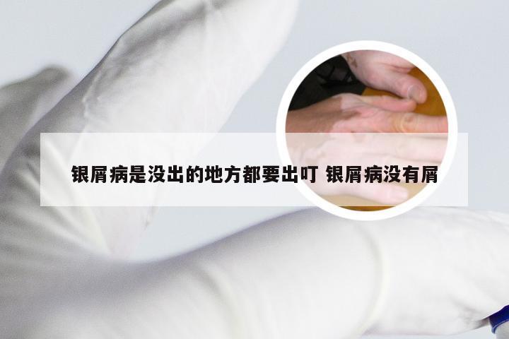 银屑病是没出的地方都要出叮 银屑病没有屑