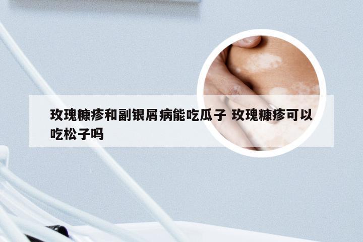 玫瑰糠疹和副银屑病能吃瓜子 玫瑰糠疹可以吃松子吗