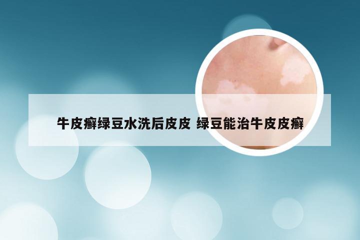 牛皮癣绿豆水洗后皮皮 绿豆能治牛皮皮癣