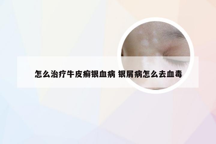 怎么治疗牛皮癣银血病 银屑病怎么去血毒