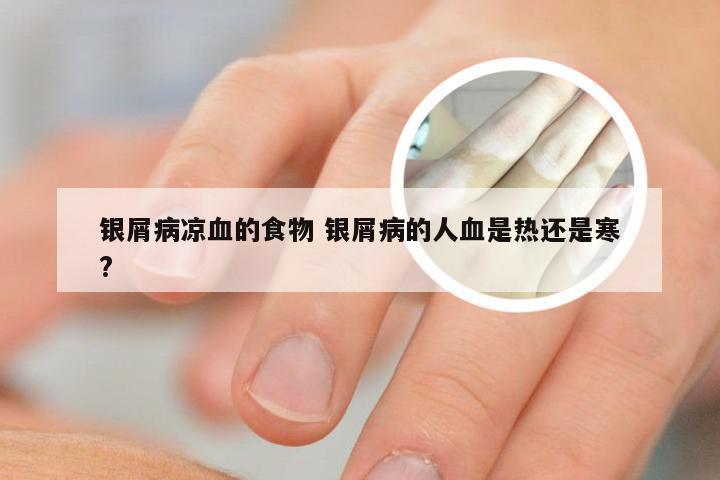 银屑病凉血的食物 银屑病的人血是热还是寒?