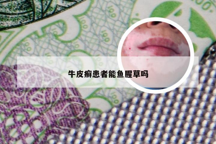 牛皮癣患者能鱼腥草吗
