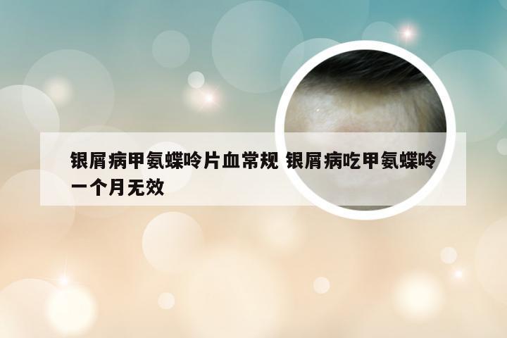 银屑病甲氨蝶呤片血常规 银屑病吃甲氨蝶呤一个月无效