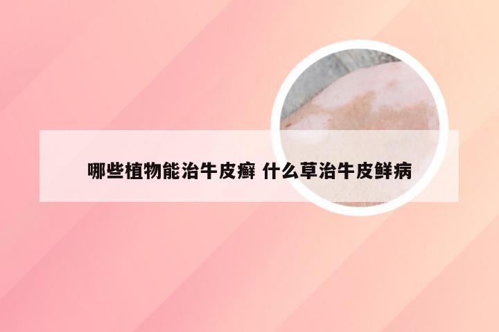 哪些植物能治牛皮癣 什么草治牛皮鲜病