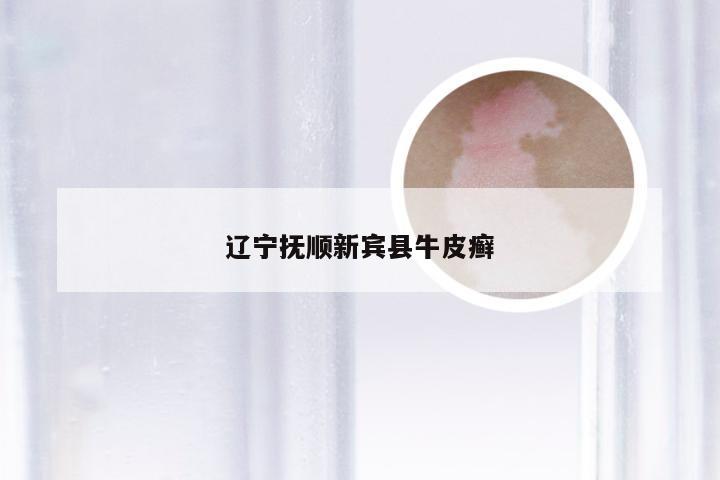 辽宁抚顺新宾县牛皮癣