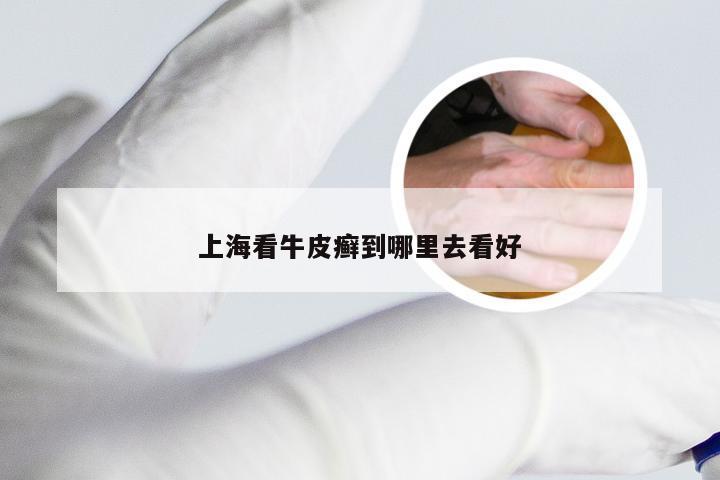上海看牛皮癣到哪里去看好