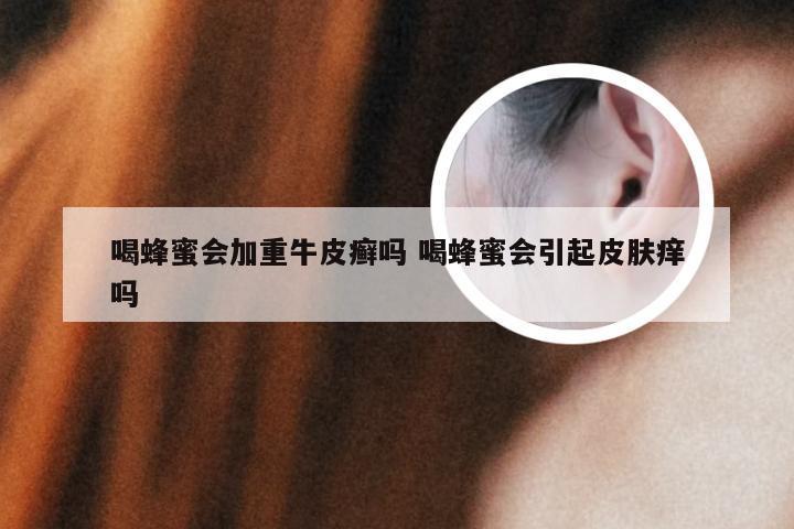 喝蜂蜜会加重牛皮癣吗 喝蜂蜜会引起皮肤痒吗