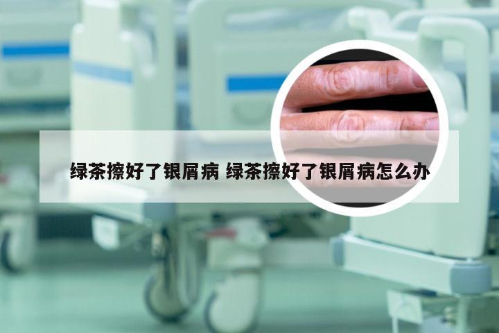 绿茶擦好了银屑病 绿茶擦好了银屑病怎么办