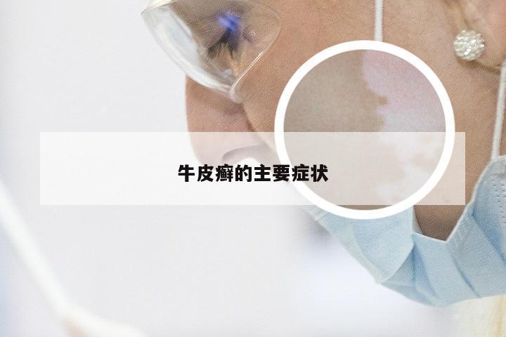 牛皮癣的主要症状