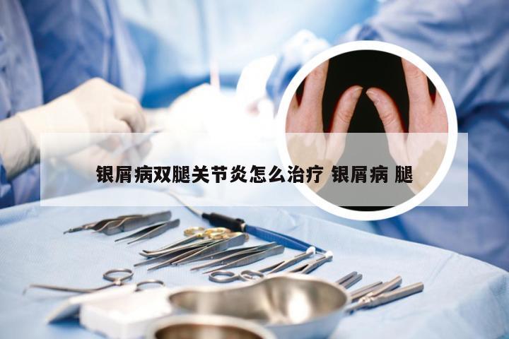 银屑病双腿关节炎怎么治疗 银屑病 腿