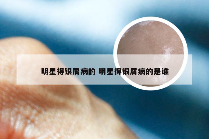 明星得银屑病的 明星得银屑病的是谁