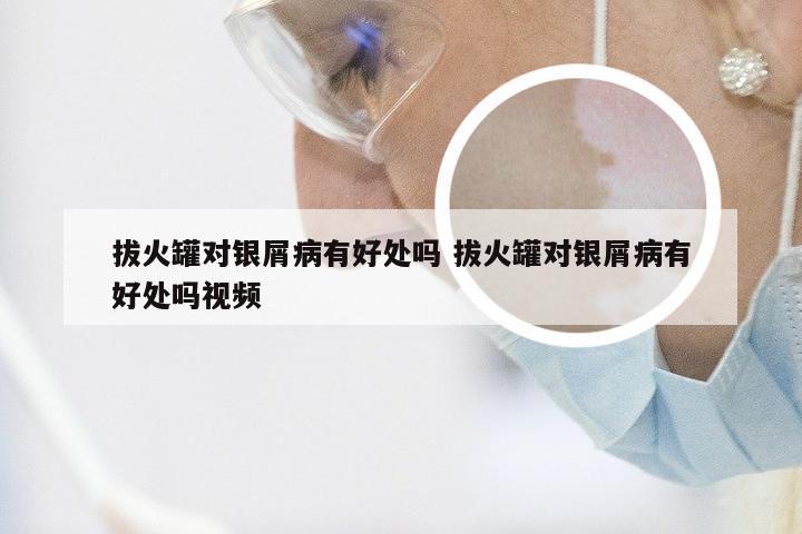 拔火罐对银屑病有好处吗 拔火罐对银屑病有好处吗视频