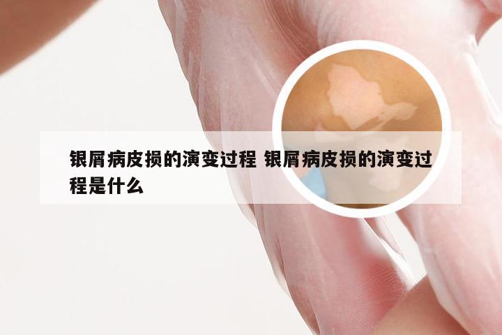 银屑病皮损的演变过程 银屑病皮损的演变过程是什么