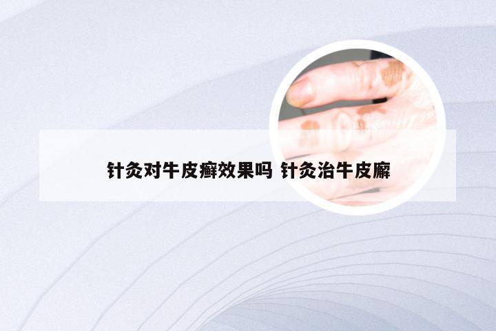 针灸对牛皮癣效果吗 针灸治牛皮廨