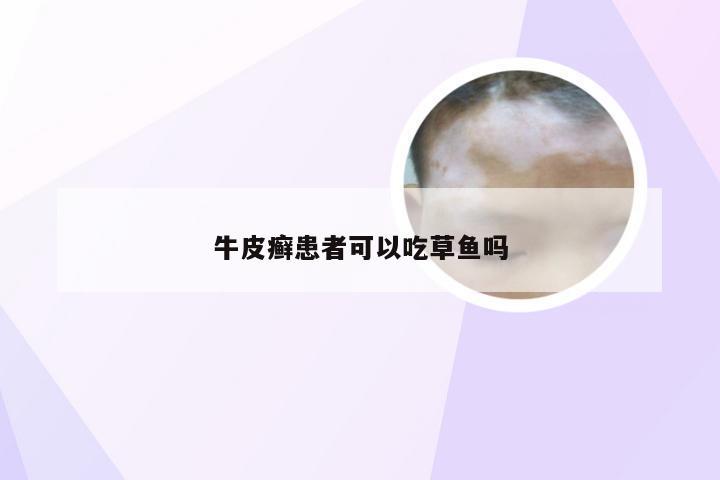 牛皮癣患者可以吃草鱼吗