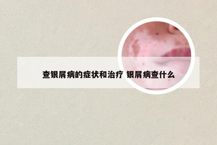查银屑病的症状和治疗 银屑病查什么