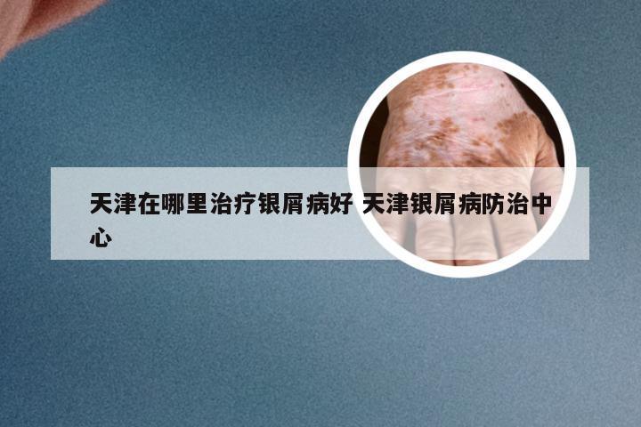 天津在哪里治疗银屑病好 天津银屑病防治中心