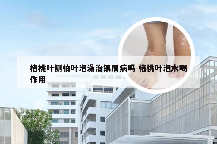 楮桃叶侧柏叶泡澡治银屑病吗 楮桃叶泡水喝作用