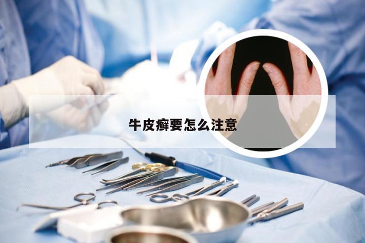 牛皮癣要怎么注意