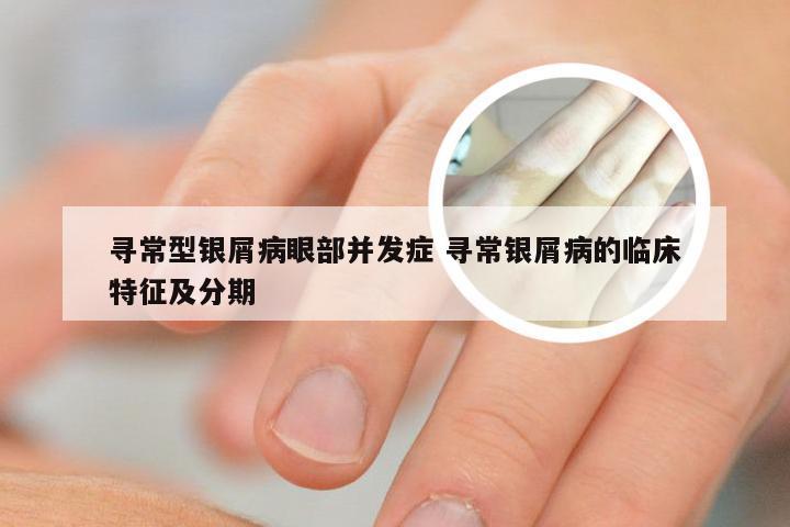 寻常型银屑病眼部并发症 寻常银屑病的临床特征及分期