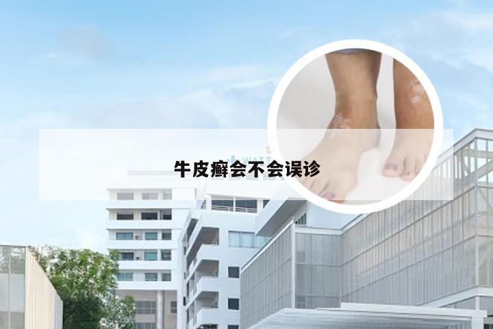 牛皮癣会不会误诊