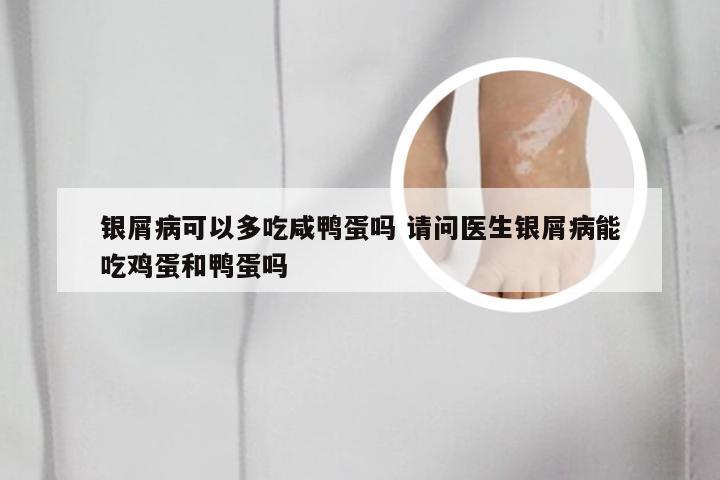银屑病可以多吃咸鸭蛋吗 请问医生银屑病能吃鸡蛋和鸭蛋吗