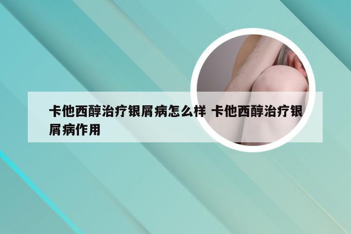 卡他西醇治疗银屑病怎么样 卡他西醇治疗银屑病作用