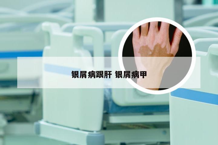 银屑病跟肝 银屑病甲