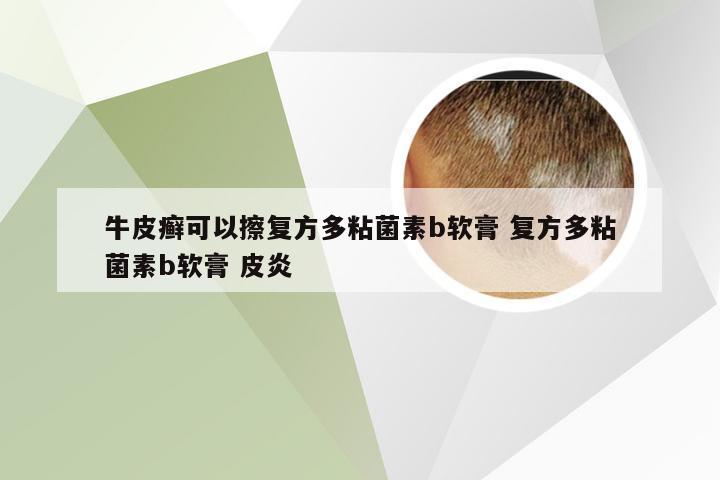 牛皮癣可以擦复方多粘菌素b软膏 复方多粘菌素b软膏 皮炎