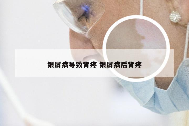 银屑病导致背疼 银屑病后背疼