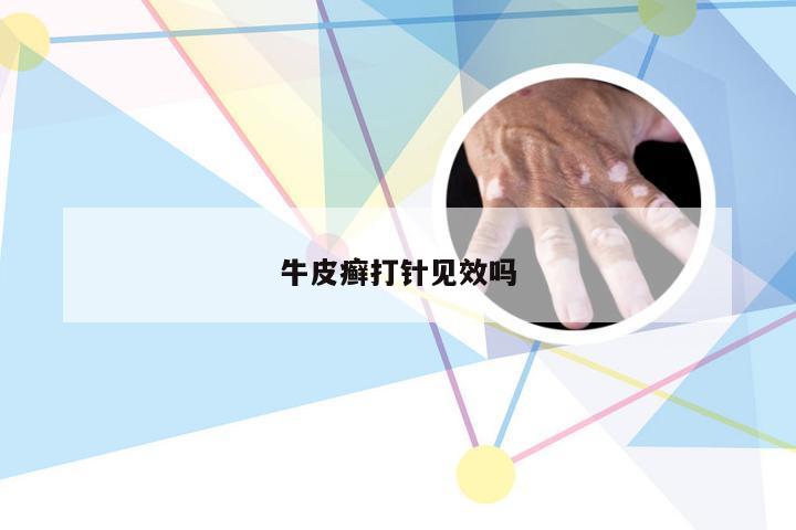 牛皮癣打针见效吗