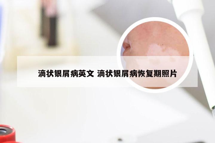 滴状银屑病英文 滴状银屑病恢复期照片