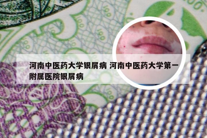 河南中医药大学银屑病 河南中医药大学第一附属医院银屑病