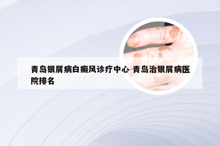 青岛银屑病白癜风诊疗中心 青岛治银屑病医院排名