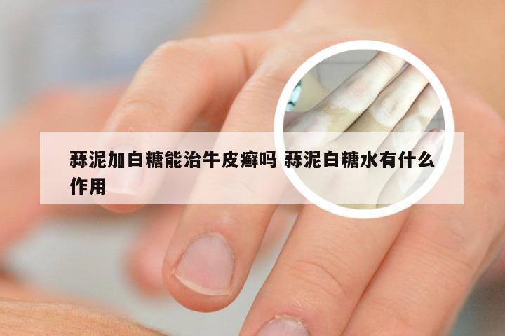 蒜泥加白糖能治牛皮癣吗 蒜泥白糖水有什么作用