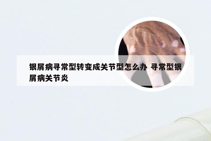 银屑病寻常型转变成关节型怎么办 寻常型银屑病关节炎