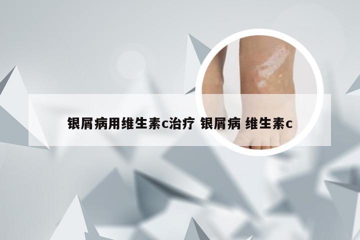 银屑病用维生素c治疗 银屑病 维生素c