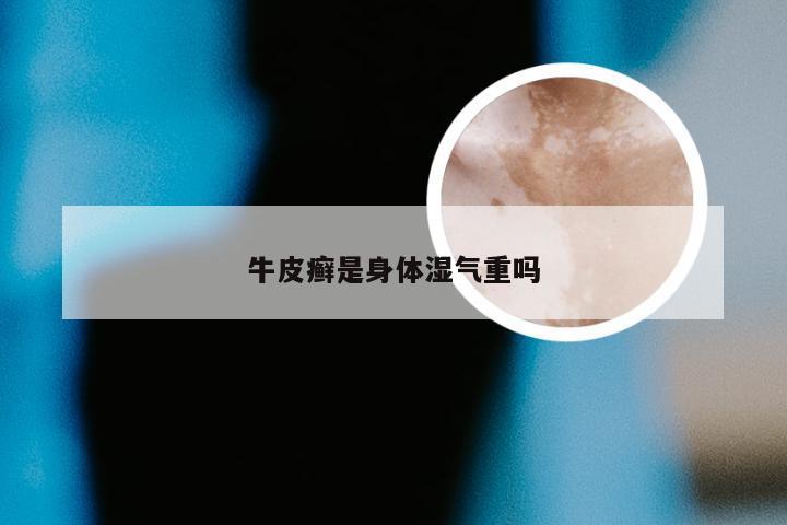 牛皮癣是身体湿气重吗