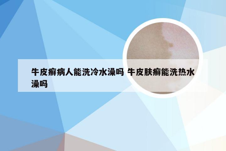 牛皮癣病人能洗冷水澡吗 牛皮肤癣能洗热水澡吗