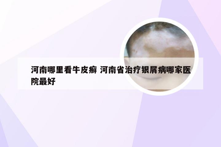 河南哪里看牛皮癣 河南省治疗银屑病哪家医院最好