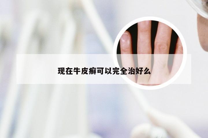 现在牛皮癣可以完全治好么