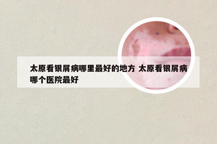 太原看银屑病哪里最好的地方 太原看银屑病哪个医院最好