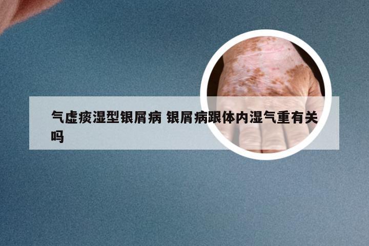 气虚痰湿型银屑病 银屑病跟体内湿气重有关吗
