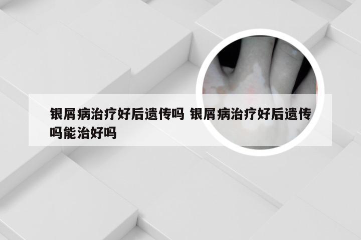 银屑病治疗好后遗传吗 银屑病治疗好后遗传吗能治好吗