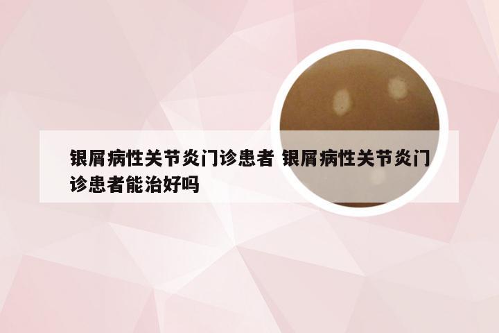 银屑病性关节炎门诊患者 银屑病性关节炎门诊患者能治好吗